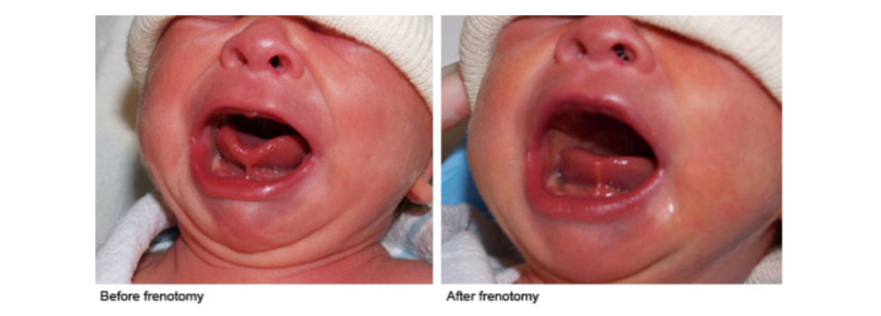 Frenotomy - tongue tie treatment